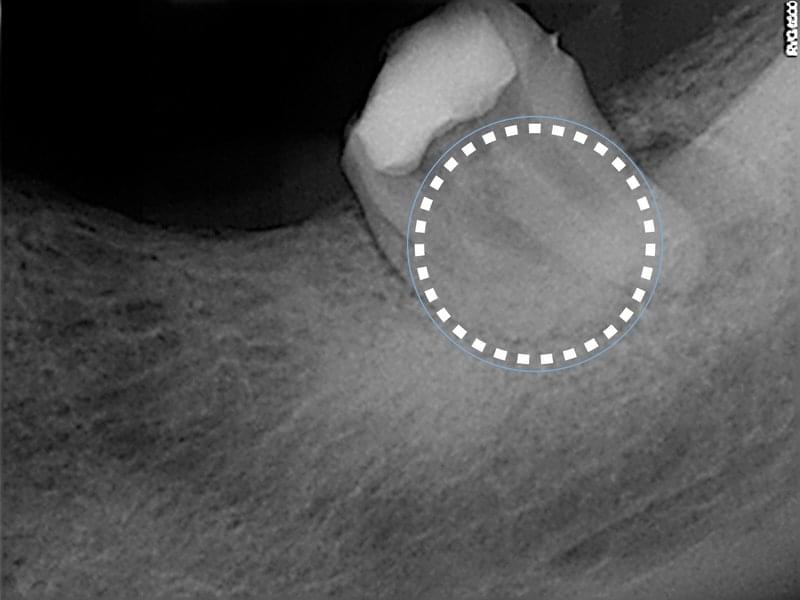 Рентгенова снимка на зъб след премахване на счупен инструмент