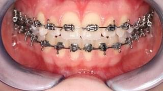 Подреждане на зъбите