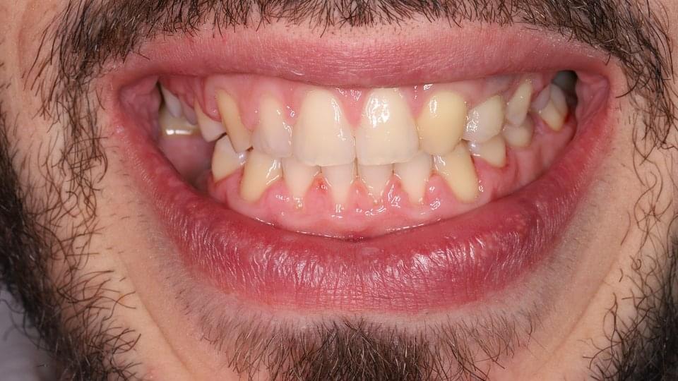 Ортодонтско лечение с брекети
