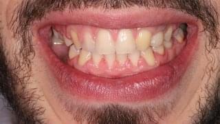 Ортодонтско лечение с брекети