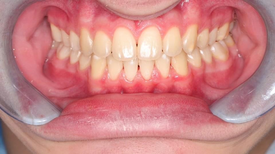 Крайният резултат са безупречно подредени зъби
