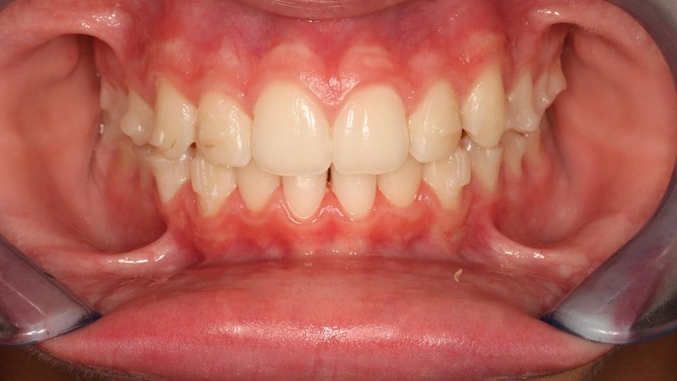 Невидими шини на горна и долна челюст