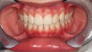 Финална усмивка