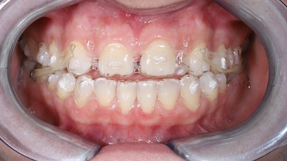 Ортодонтско лечение с невидими шини