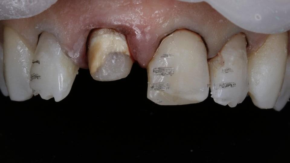 Етап от препарацията на зъбите