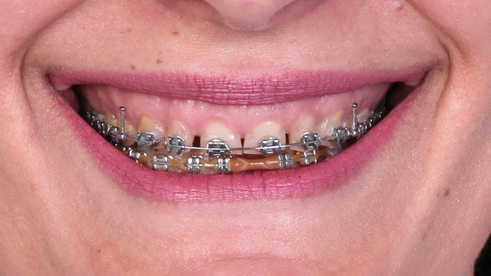 Ортодонтско лечение
