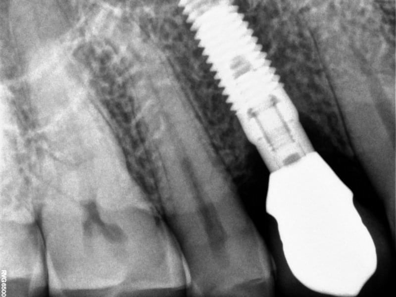 Рентгенова снимка на зъбен имплант