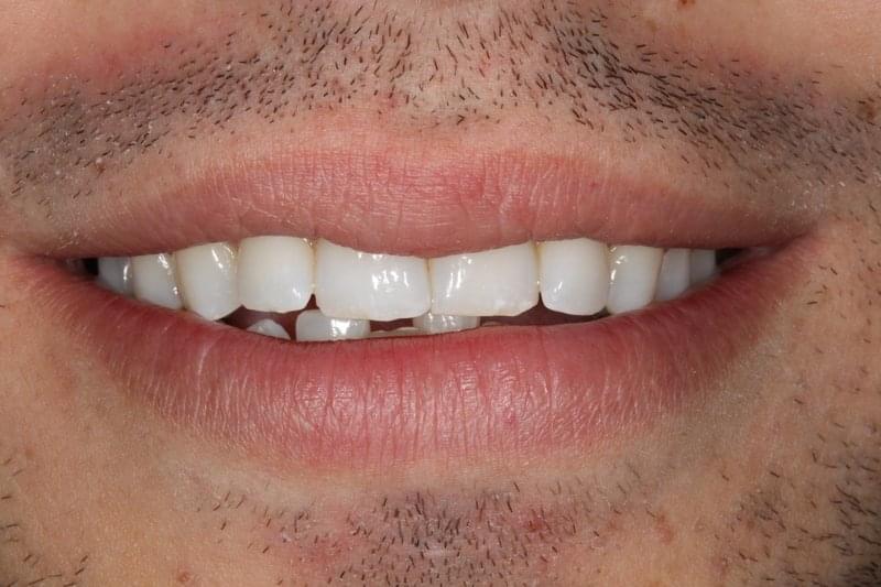 Избелване на зъби в домашни условия