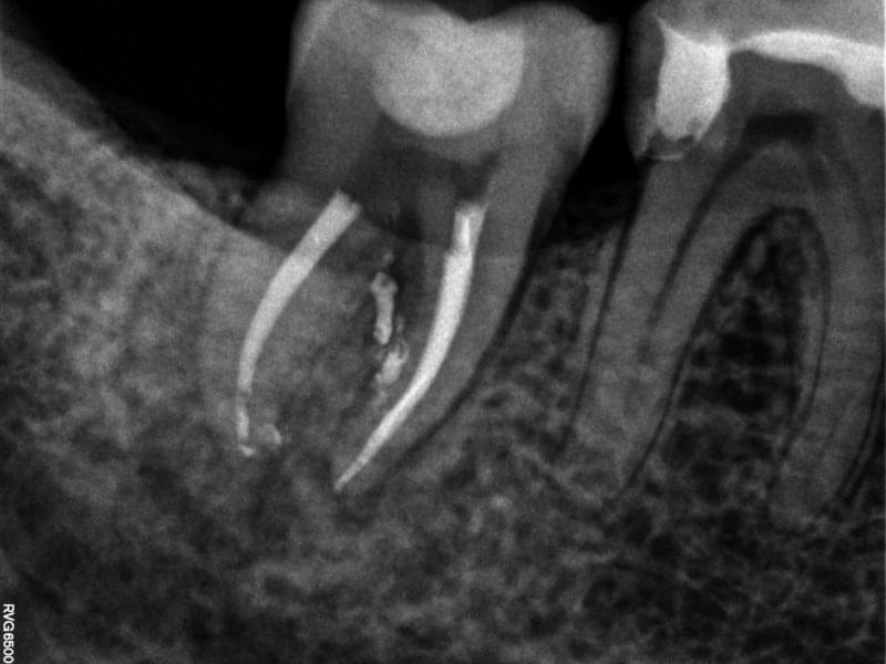 Рентгенова снимка на коренови канали