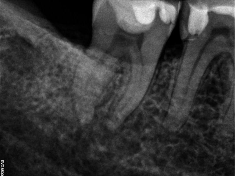 Рентгенова снимка на лечението на коренови канали