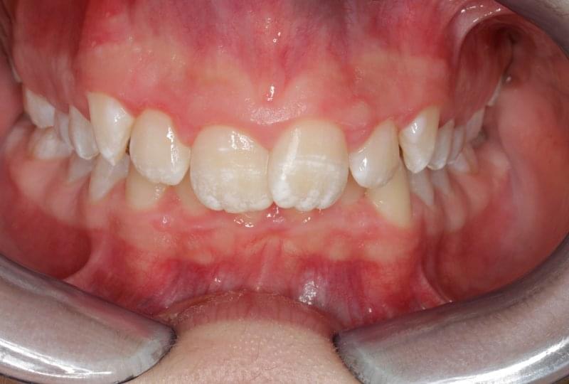 Преди ортодонтското лечение с Invisalign