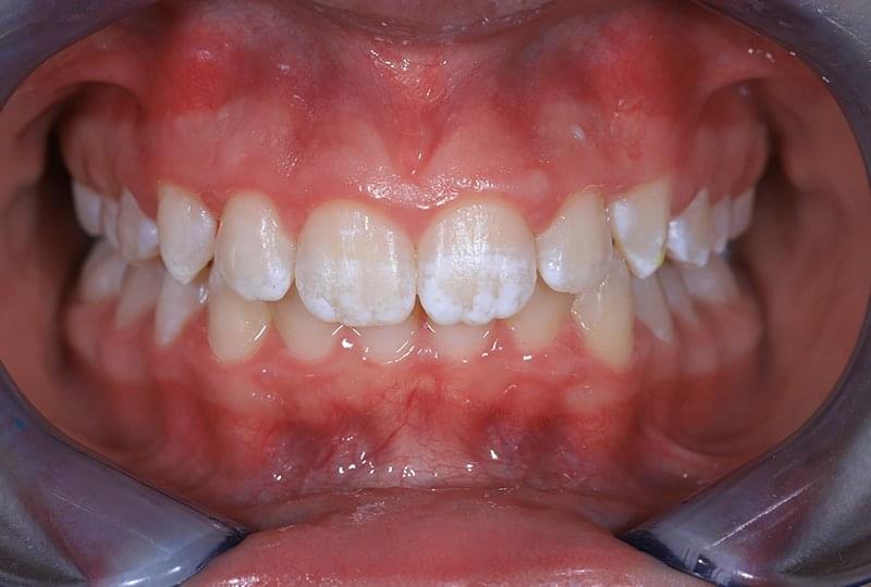 След ортодонтското лечение с Invisalign
