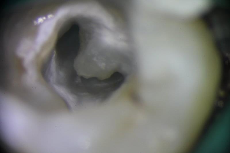Микроскопска снимка на коренов канал