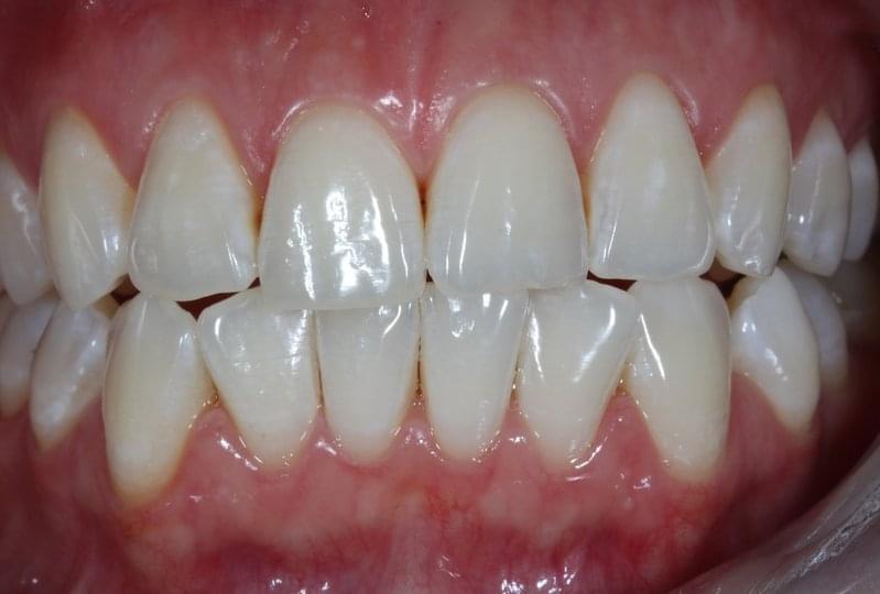 Резултат от избелването на зъби в домашни условия