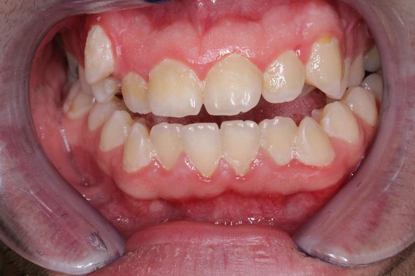 Кои са вредните навици, които водят до ортодонтски деформации?