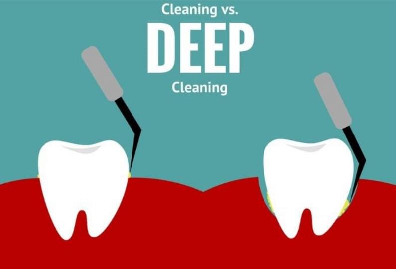 Какво представлява дълбокото почистване на зъбен камък?