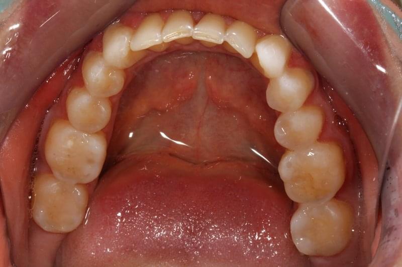 Начален вид при изтриване на зъбите