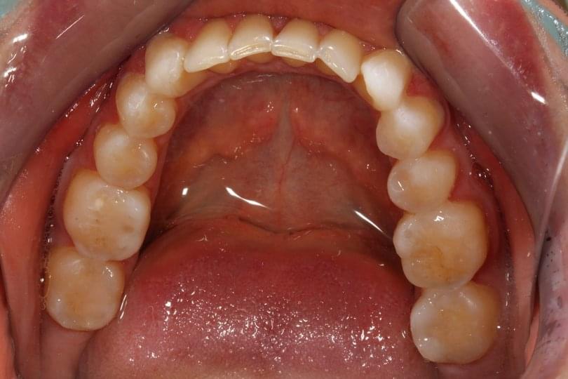 Корекция на изтрити зъби