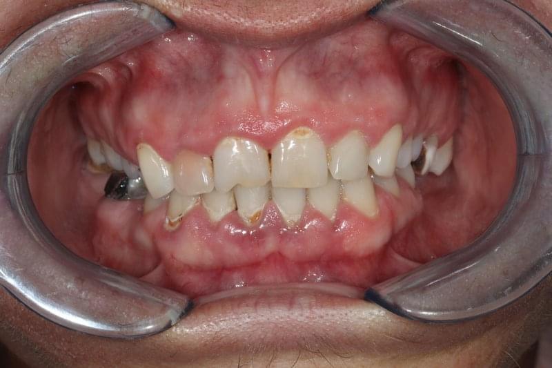 Как влияе тютюнопушенето върху здравето на венците и зъбите?
