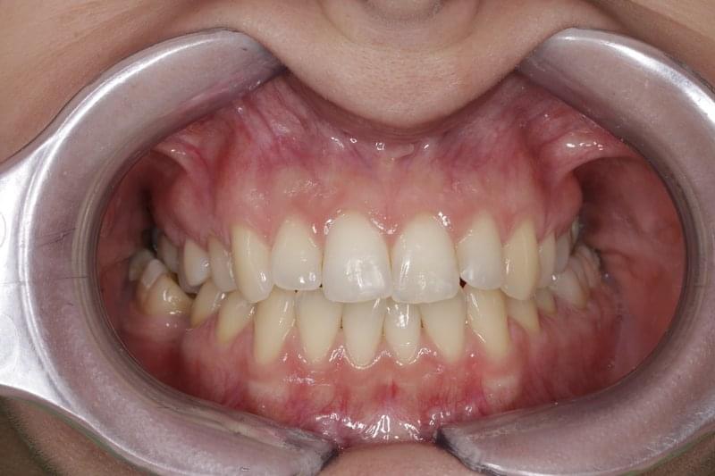 Състояние на венците след започване на лечението