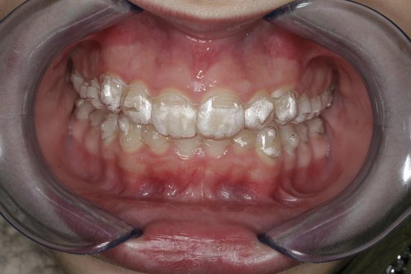 Невидимо ортодонтско лечение - Invisalign (Инвизалайн)