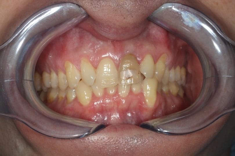 Опасности при умъртвяването на зъб с арсен