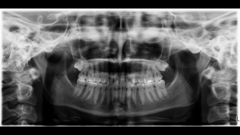 Разрушен зъб на нивото на венеца
