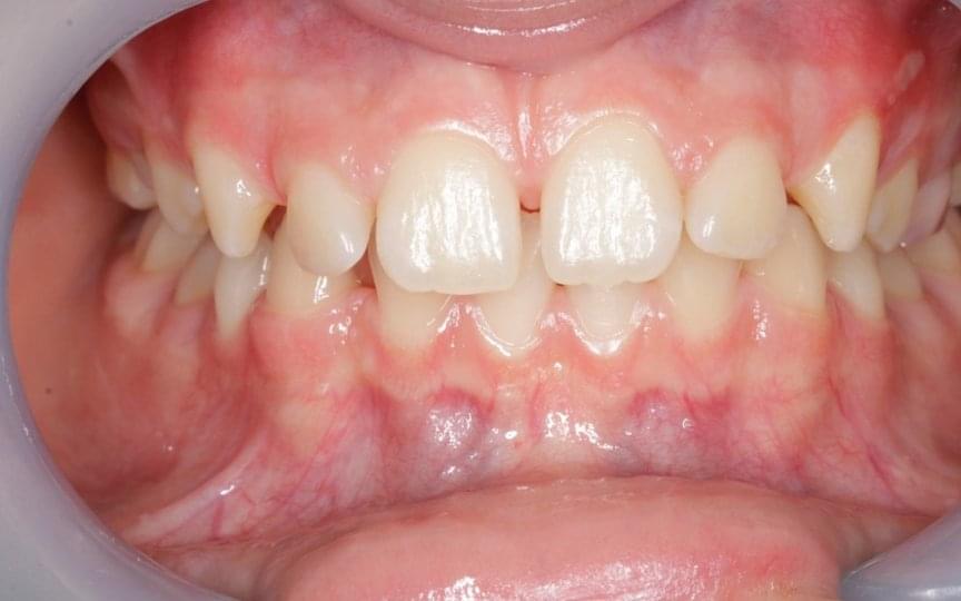 Ортодонтско лечение при разстояние между зъбите