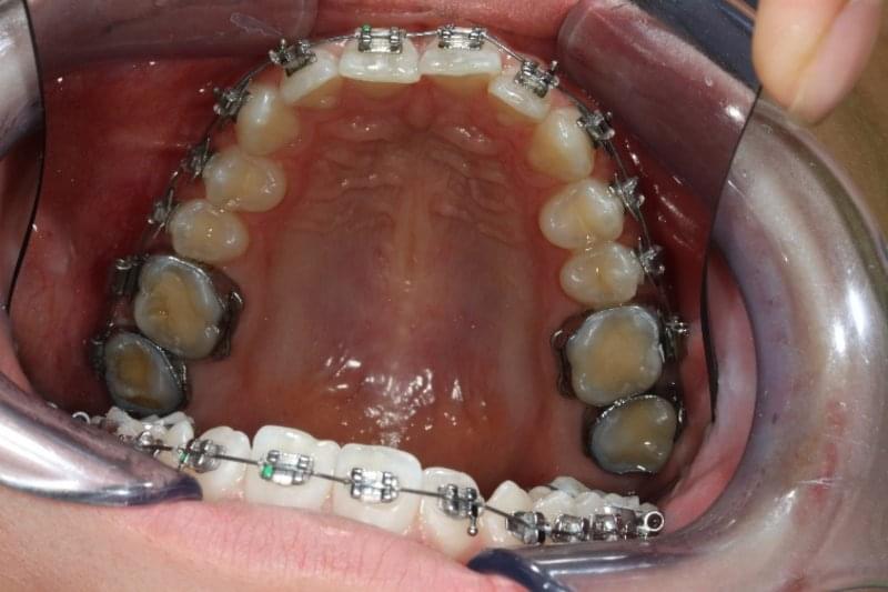 Преди ортодонтското лечение