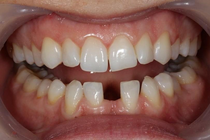 Поставяне на зъб без хирургична намеса