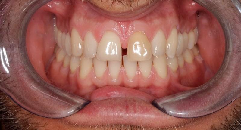Затваряне на разстояние между зъбите