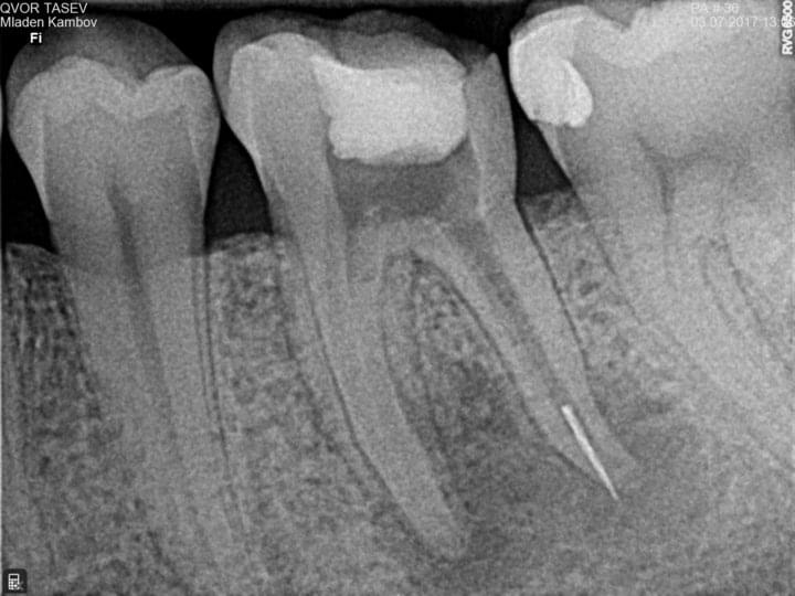 Премахване на счупен инструмент в зъб