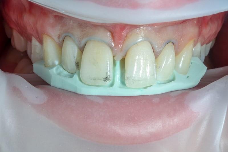 Подготовка на зъбите
