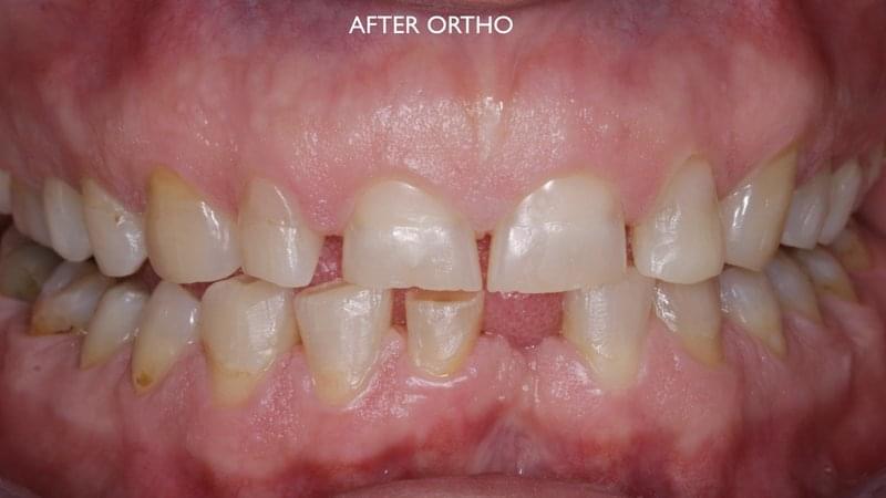 Етап от ортодонтско лечение
