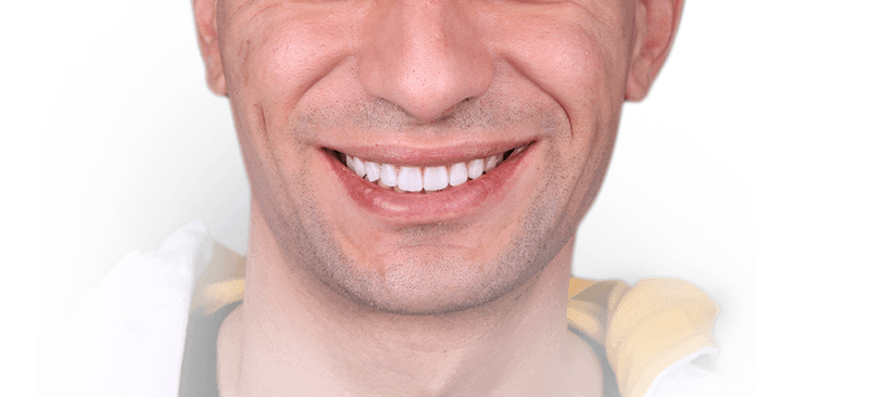 Естетична корекция на изтрити зъби - Пълна промяна