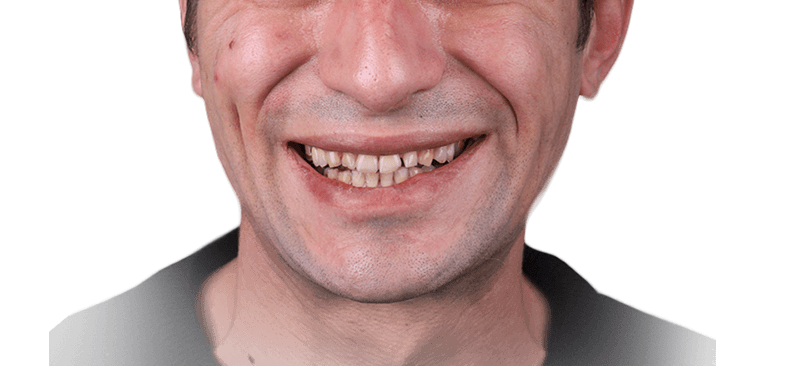 Естетична корекция на изтрити зъби - Начално състояние