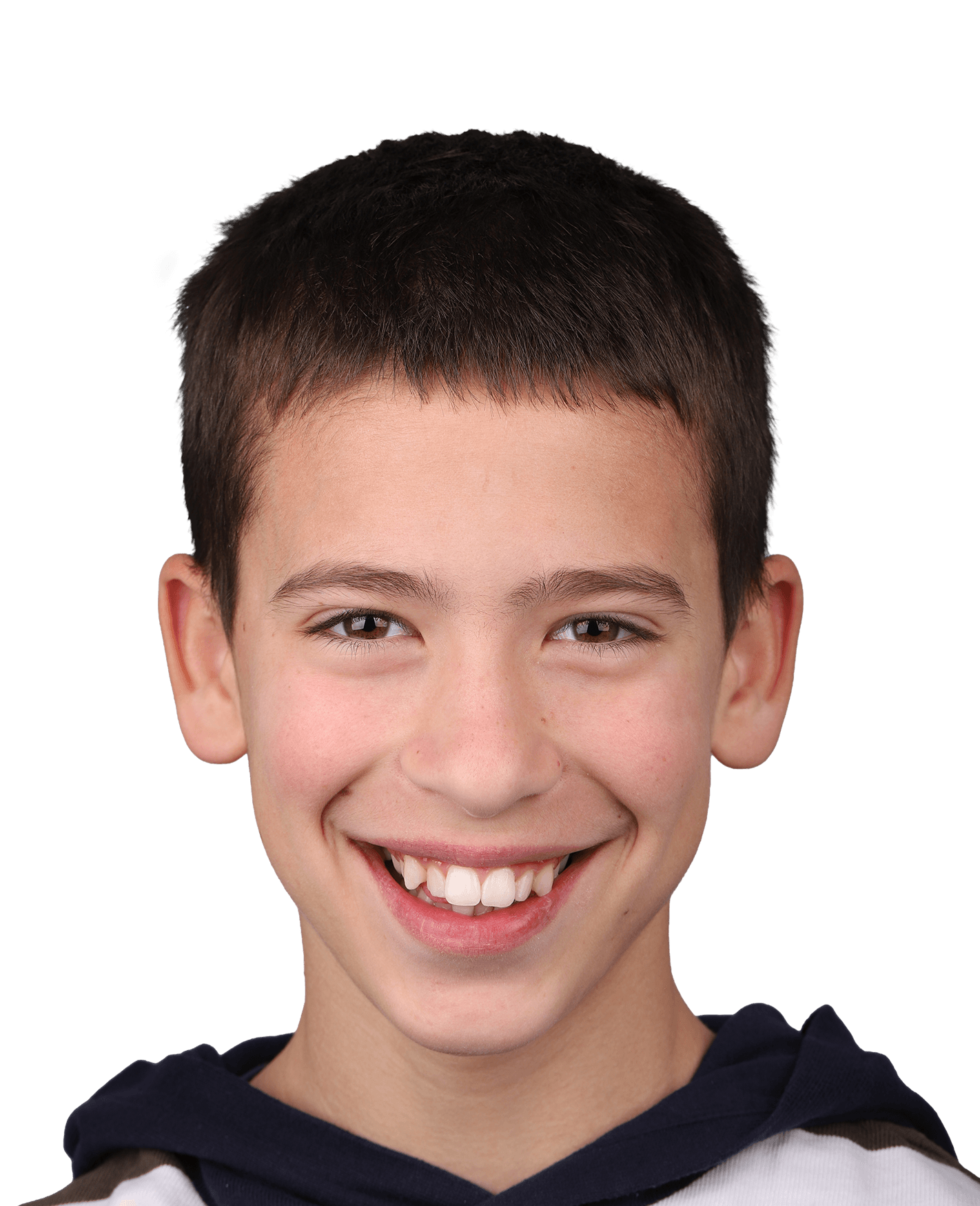 Струпани зъби и дистална захапка - Начално състояние