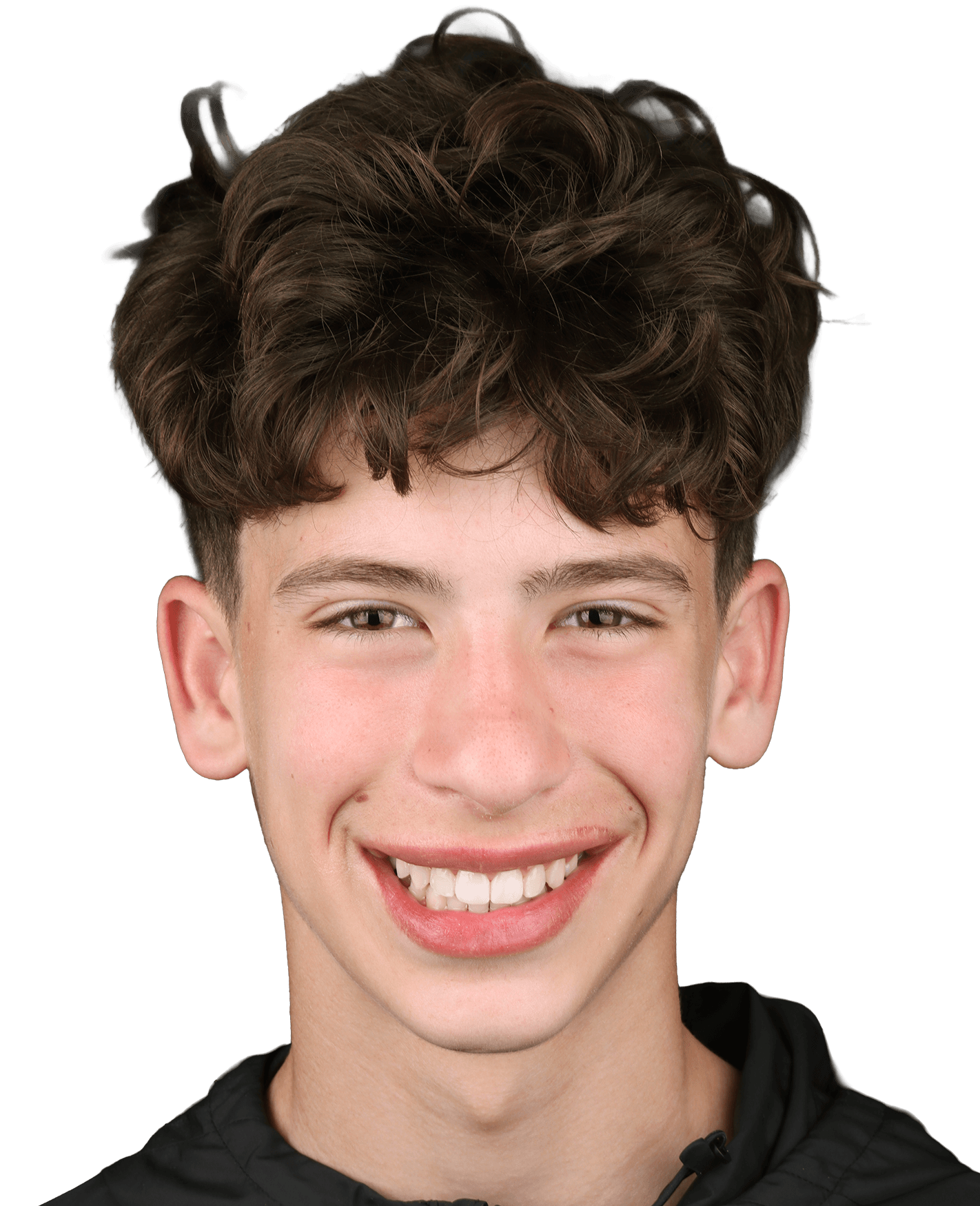 Струпани зъби и дистална захапка - Пълна промяна