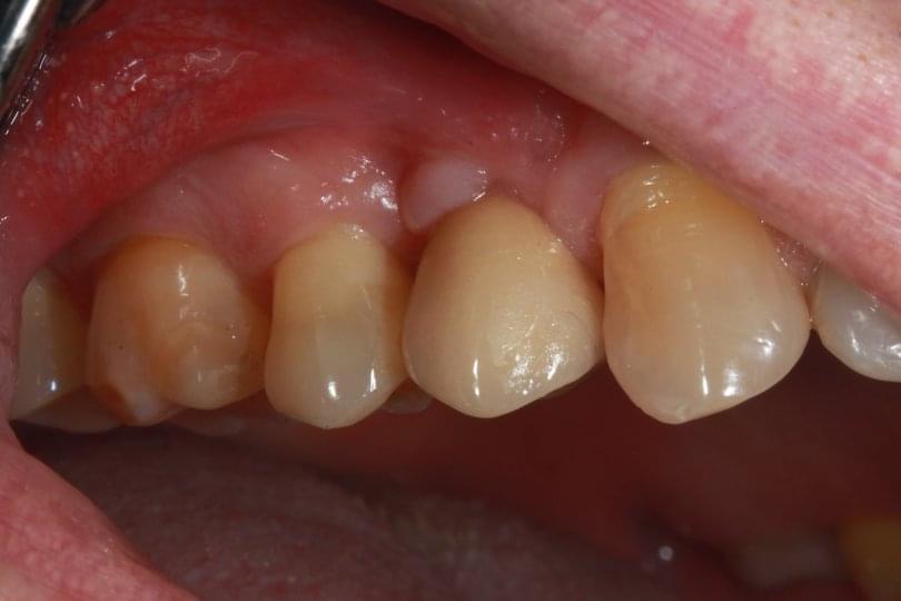 Възстановяване на зъб с имплант
