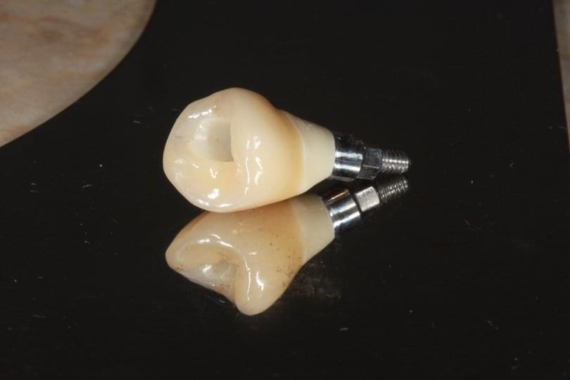 Зъбен имплант