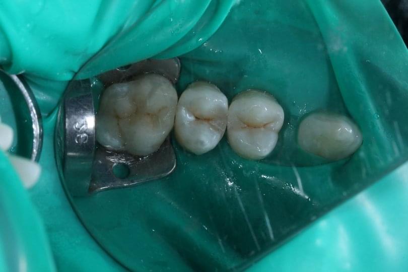 Възстановяване на зъб с керамичен инлей