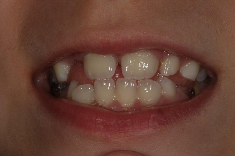 Грижа за временните зъби при децата