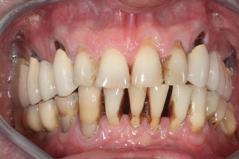 Последствия при непочистване на зъбен камък