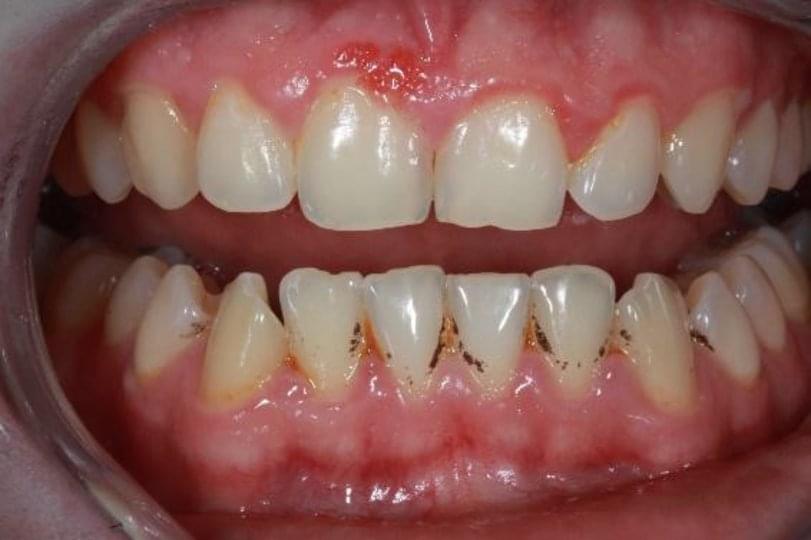 Причини за оцветявания по зъбите